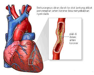 Penyakit Jantung Koroner