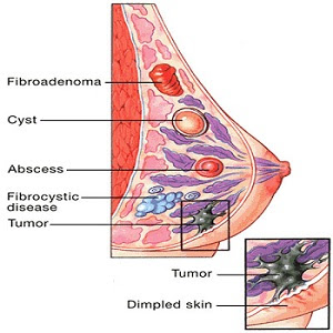 fibroadenoma.