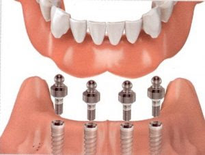 Trồng răng sứ bằng cấy ghép răng Implant 
