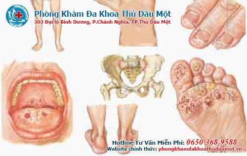 Sự giống nhau và khác nhau giữa bệnh lậu và Chlamydia