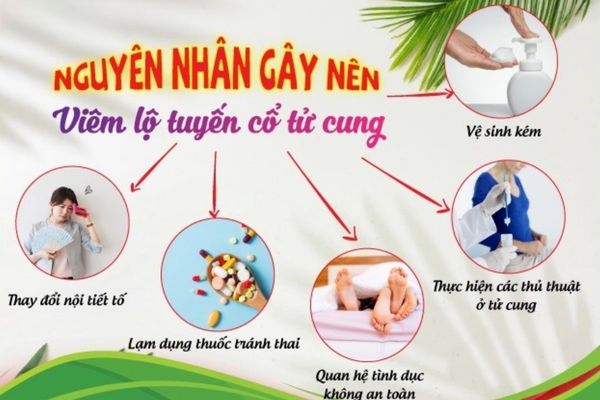 Nguyên nhân bị viêm lộ tuyến