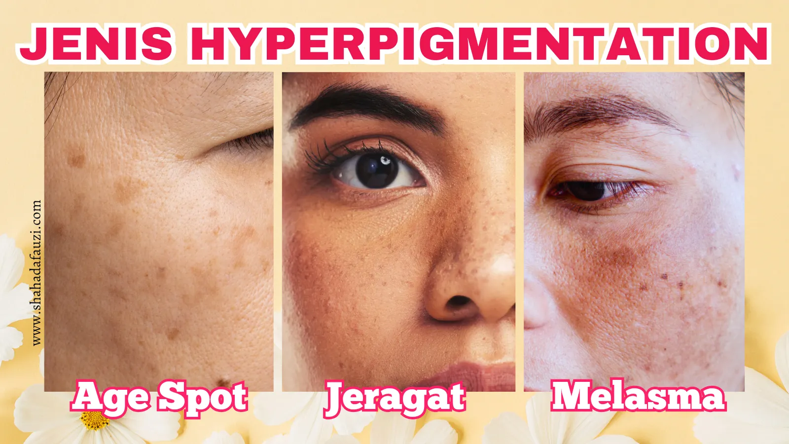 Jenis Hyperpigmentation