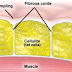 ما هو السليوليت cellulite ؟ وما هي أهم الأطعمة التي تساعد علي التخلص منه 