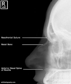 TEKNIK RADIOGRAFI NASAL