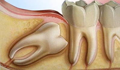 Răng khôn mọc ở vị trí nào