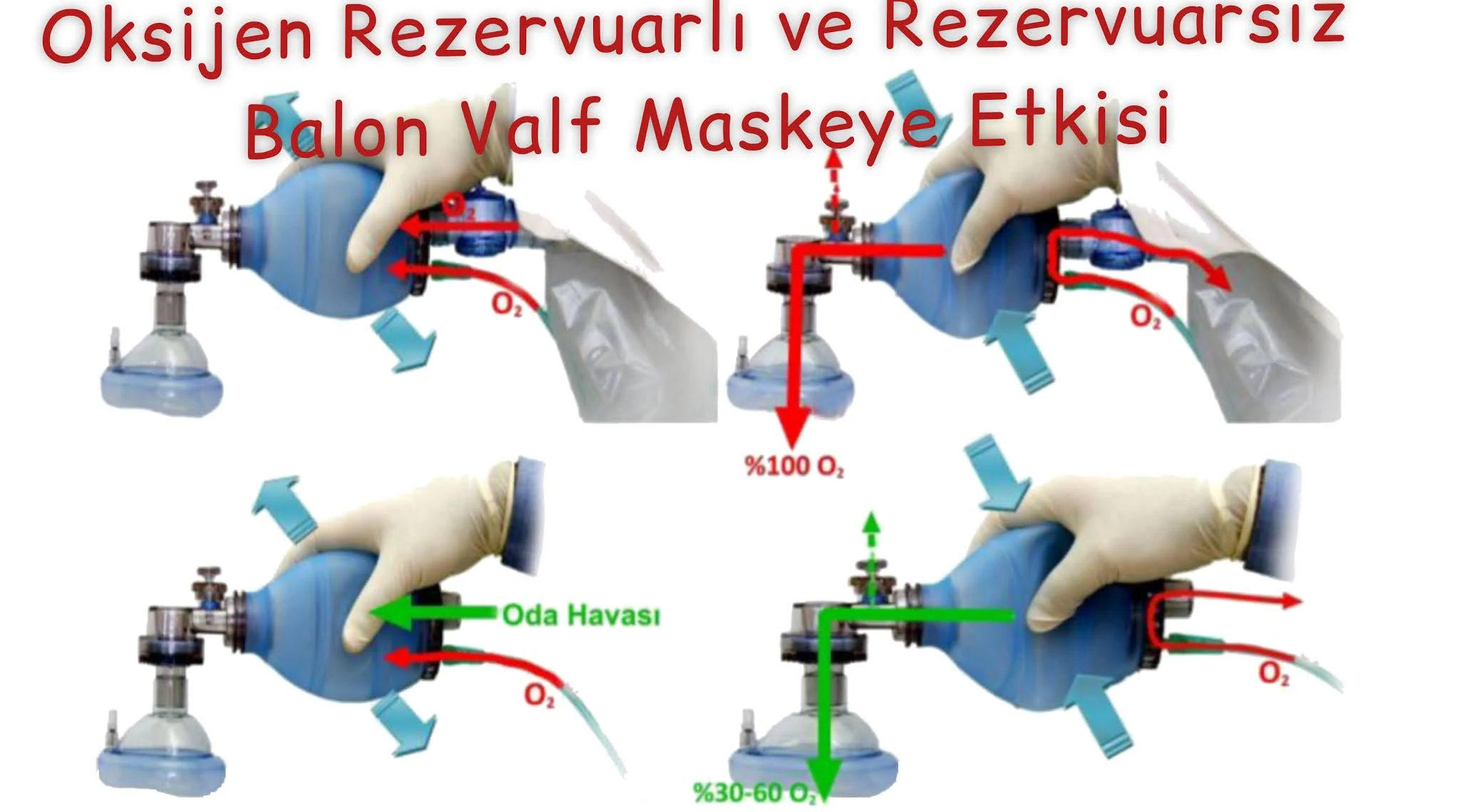 Oksijen Rezervuarlı ve Rezervuarsız balon valf maskeye Etkisi