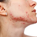 What Causes Acne Vulgaris