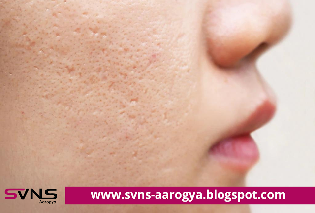  Healthy Skin | चेहऱ्यावरचे खड्डे दूर करण्यासाठी ‘असे’ करा घरगुती उपाय