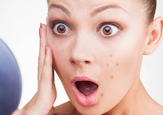 Acne - What Causes Acne?