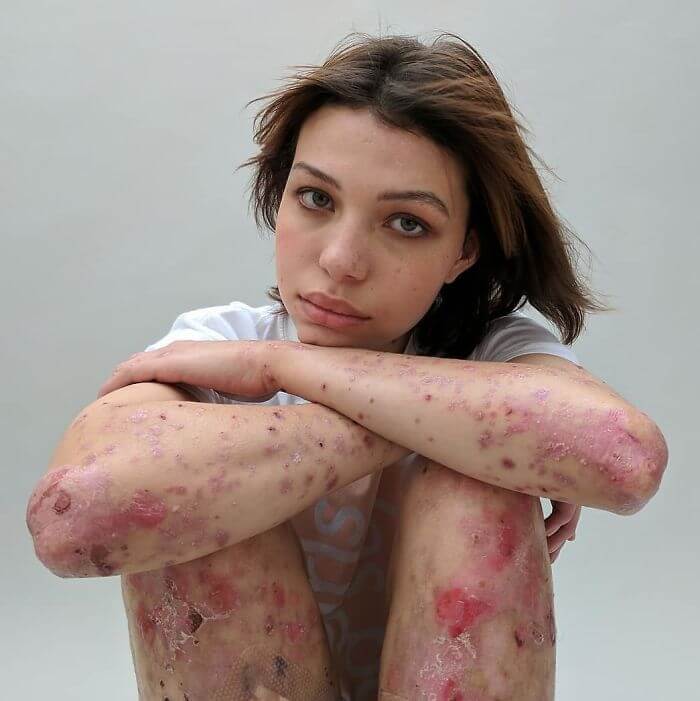 Photographer Captures People And Their Unique Scars In An Inspiring 'Behind The Scars' Photo Project