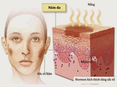 cách trị nám da mặt từ thiên nhiên