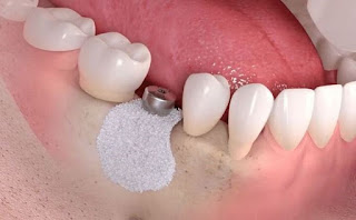 Trồng răng implant có đau không-3