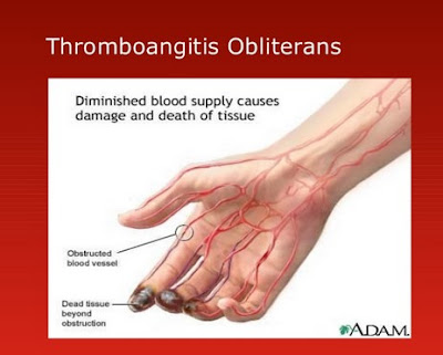 Peripheral Vascular Disease Pictures