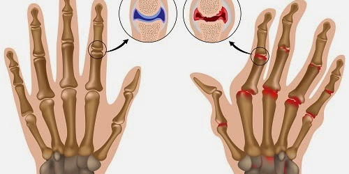 Alimentos Super Especiales Contra la Artritis