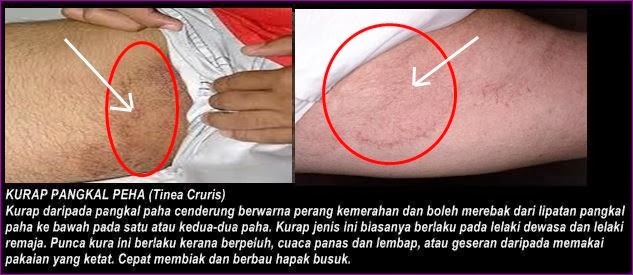 Ubat dan Penawar penyakit kurap dan Gatal-gatal tubuh