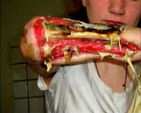  Krokodil: A droga zumbi russa que faz viciados apodrecerem vivos!