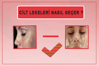 Cilt Lekeleri Nasıl Geçer