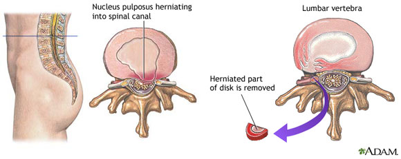 Hernia nukleus pulposus