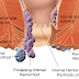 Cara Mengatasi Wasir Yang Bengkak