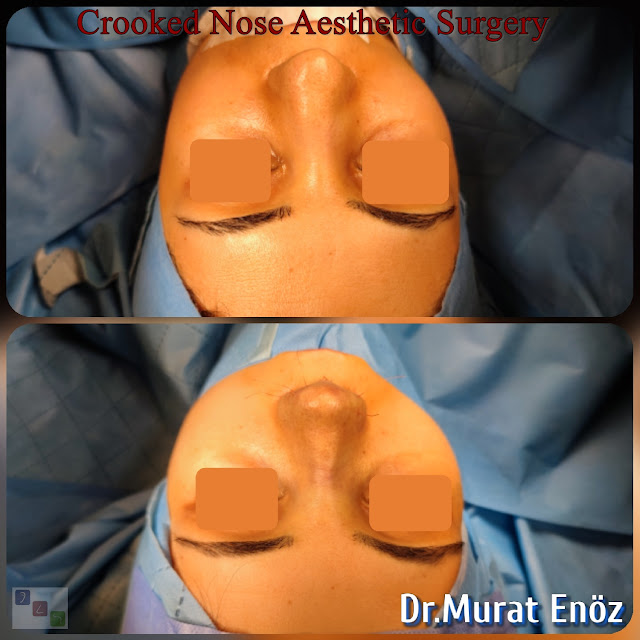 Rhinoplasty Operation For Crooked Nose,Crooked Nose Aesthetic Surgery For Female,Twisted Nose Rhinoplasty,