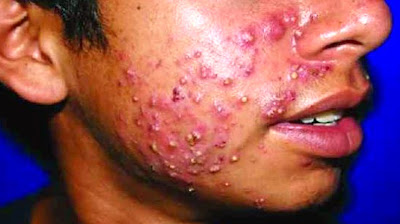 skin disorders acne