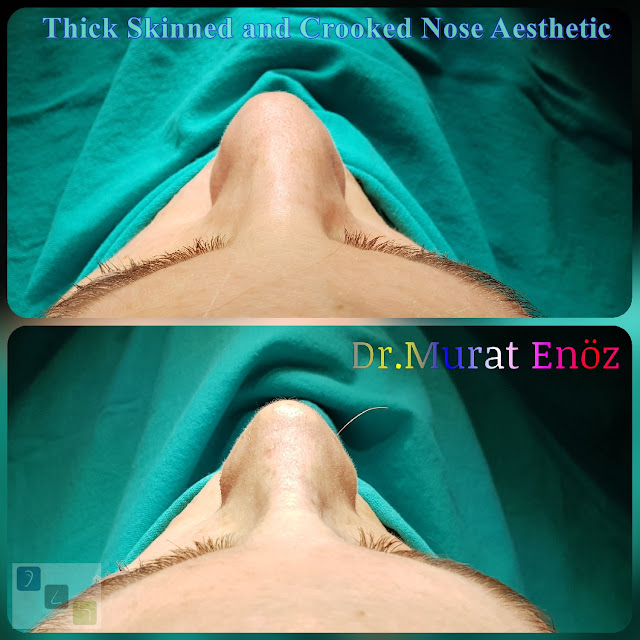 Crooked Nose Aesthetic,Female Nose Job, Rhinoplasty in Istanbul