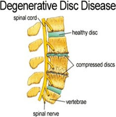 Degenerative Disc Disease Pictures