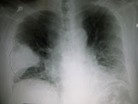 X-ray showing Pneumonia