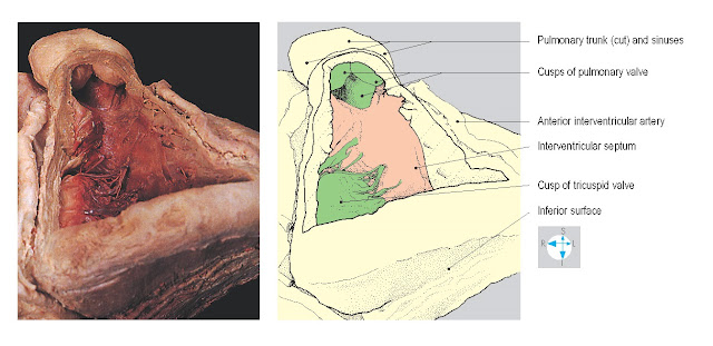 Ventricular surfaces of the cusps of the pulmonary valve seen after removal of part of the anterior wall of the right ventricle.