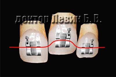 Биомеханика работы брекет системы