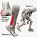 Achilles Tendon injury- Detailed Information on Injury