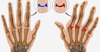 Obat asam urat apa aja, ciri ciri sakit asam urat dan pengobatannya, cara menghilangkan nyeri kaki akibat asam urat, manfaat es batu untuk asam urat, asam urat buat kaki bengkak, asam urat who, obat generik untuk sakit asam urat, bolehkah penderita asam urat dipijat, obat asam urat kambuh, hubungan asam urat dengan darah tinggi, cara tradisional mengobati asam urat dan rematik