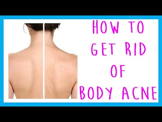 Easy Ways To Treat Body Acne