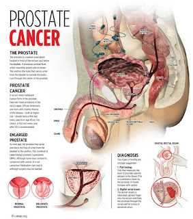 Kanker Prostat, Mau Tahu Apa Saja Faktor Penyebabnya?