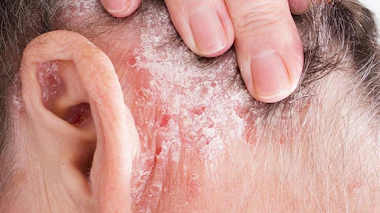 IDENTIFICADA UNA MUTACIÓN GENÉTICA RESPONSABLE DE LA PSORIASIS