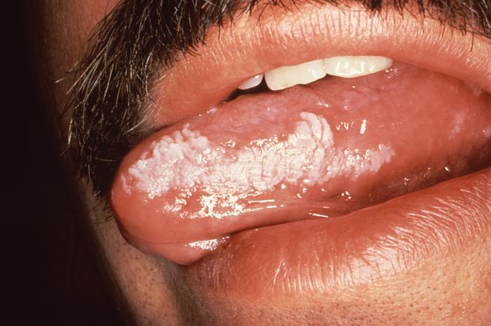 Leukoplakia