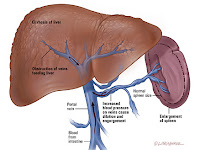 Obat Liver Tradisional 