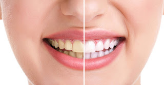 Tẩy trắng răng với kỹ thuật Halogen