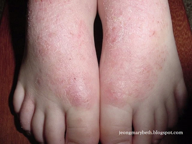 발의 비특이적 피부염 이미지