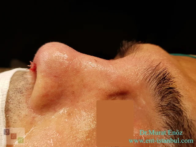 Male Rhinoplasty,Revision Rhinoplasty Operation With Rib Cartilage,Tertiary Revision Nose Aesthetic Surgery,Tertiary Revision Nose Job in Istanbul,