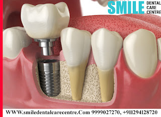 Best Dental Implant in Faridabad