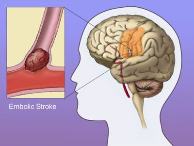 the signs of a stroke are?