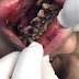 Dentist aback !! Flies in her gums (Video)