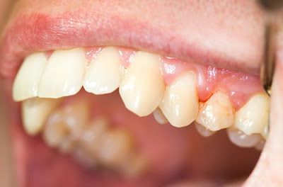 Giữa răng sâu có cục đỏ dễ bị chảy máu?