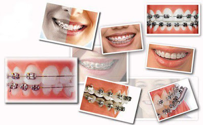 Niềng răng chỉnh nha có lợi ích gì?