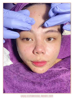 Lineation Doublesoft Iontho Treatment