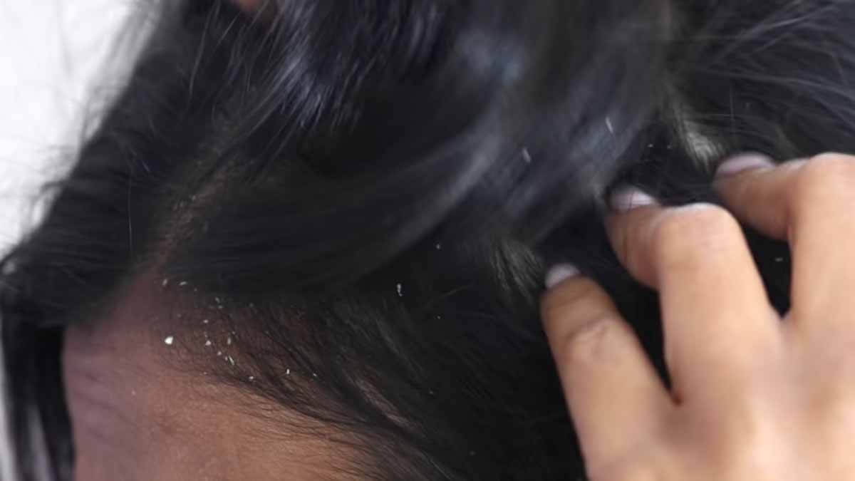 Do you know the best at home treatments for dandruff
