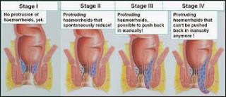 Jenis-Jenis dan Stadium Penyakit Ambeien