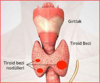 tiroid nodülü