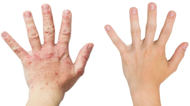 https://www.healthandfitnessexpert.in/2024/04/psoriasis-symptoms-couses-and-treatment.html